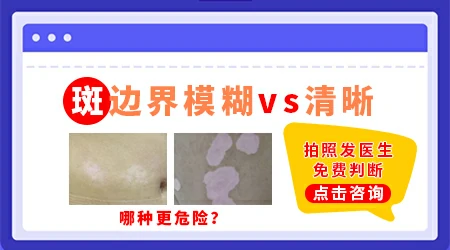 白癜风白斑边缘变模糊是好还是不好