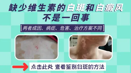 儿童缺维生素脸上长白块和白癜风区别图片