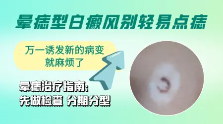 脸上晕痣型白癜风好治疗吗
