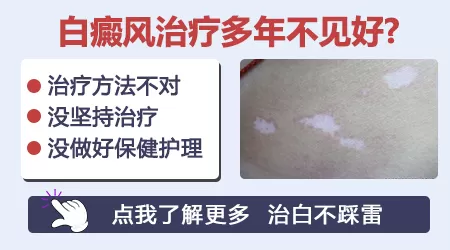 手指白癜风照308激光多次没好转还用继续吗