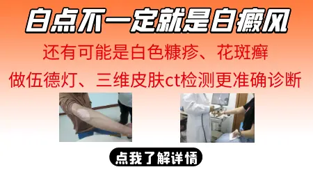 指甲周围出现白斑算不算白癜风
