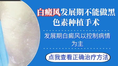 进展期的白斑能不能直接做表皮移植