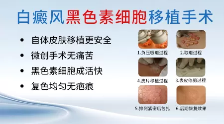 面部白癜风移植手术后会不会留疤