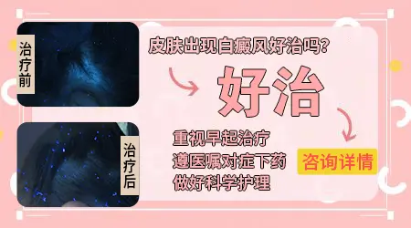 现在白癜风到底能看好吗 怎么治好