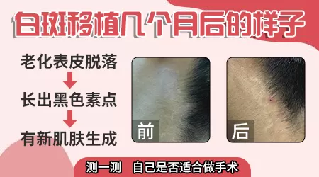 做黑色素移植术后要多久才能看到成活效果