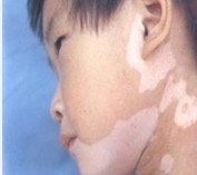 小孩的皮肤为什么会长白斑