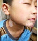 儿童免疫力低下引起的白癜风好治吗