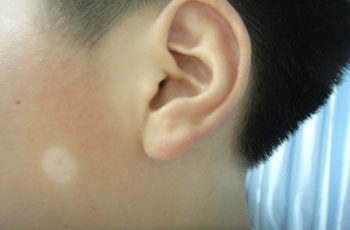儿童白癜风是什么引起的能治吗