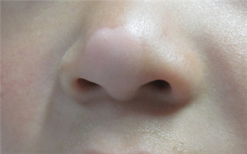 7岁女宝挑食鼻子旁边白了一大块