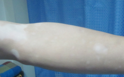 孩子胳膊有小白点是不是白癜风怎么看