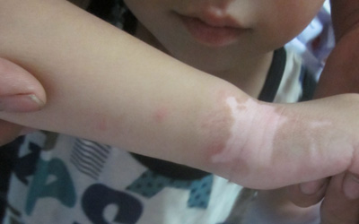 小孩子胳膊上有一小堆白斑