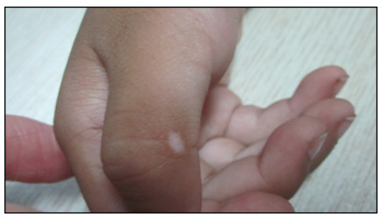 幼儿白癜风早期症状图片