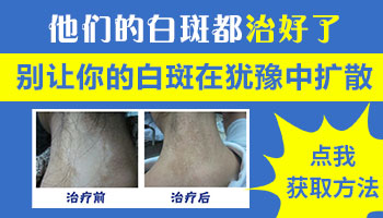 男性手上脚上白癜风还在慢慢扩大