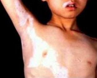 女人白癜风患者应当怎样颐养