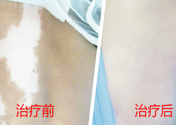 女人指甲上有白点是怎样回事