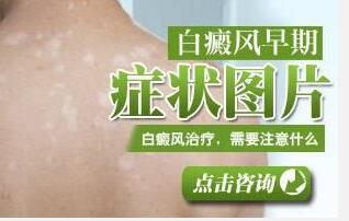 女人白癜风怎样治疗是选择