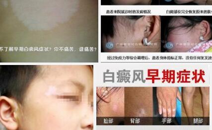 为什么女人冗杂患有白癜风