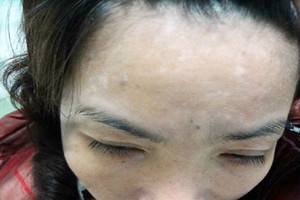 治疗女性白癜风患者应该怎么做