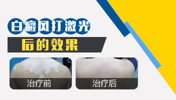 哺乳期长白癜风可以用药吗 怎么治疗安全