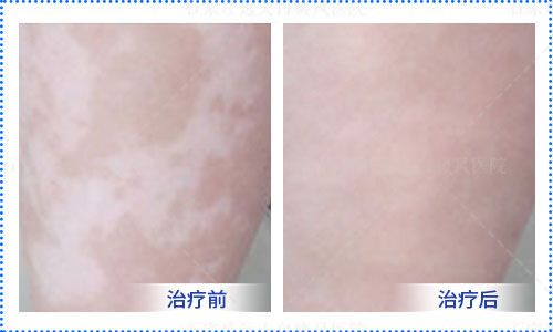 女人大腿内侧有大白斑块
