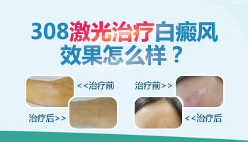 17岁男孩手臂白癜风还能参加高考吗