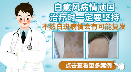 高中生脸上一块白癜风怎么治 能不能治好