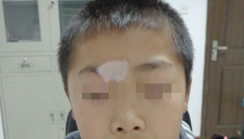 确诊小孩白癜风需要做什么检查