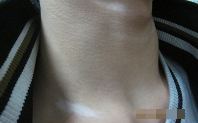 脖子上的一块皮肤变白了很光滑是什么病