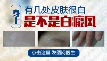 隐私部位长白斑是外阴白斑还是白癜风