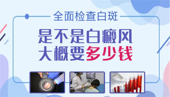 额头有一片白斑是不是白癜风 做什么检查能确诊