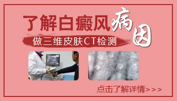 伍德灯检查白斑蓝白色就一定是白癜风吗