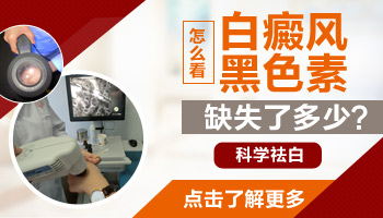 怎么看大腿上的白块是不是白癜风
