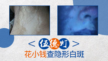 伍德灯下白斑稍微泛白是怎么了