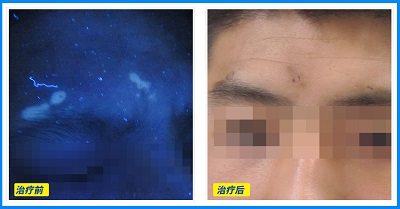 怎样用伍德灯看是不是白癜风