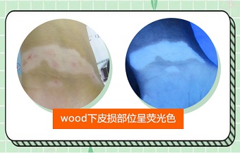 wood灯下可见瓷白色亮片是白癜风吗