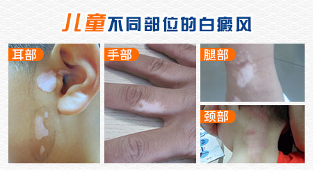 新生儿大腿根发白是得了什么病