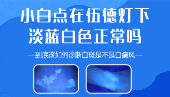 伍德灯下淡蓝白色荧光是白癜风吗