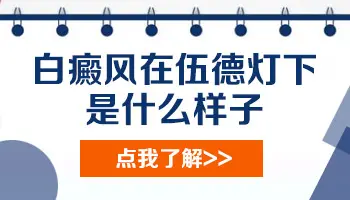 伍德灯检查白斑呈淡蓝色是白癜风吗