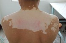 女性背部初期白癜风有哪些症状