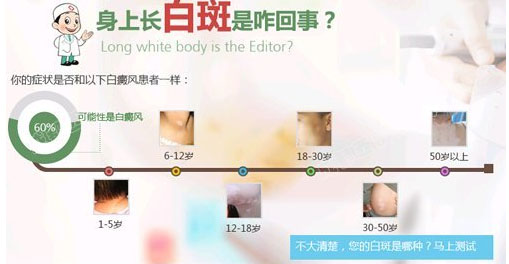 白癜风的症状常识有哪些