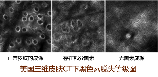 节段型白癜风症状有哪些