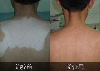 儿童白癜风早期症状什么样