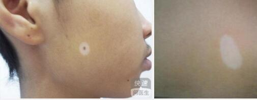 白癜风除了不规则的圆斑还有什么症状