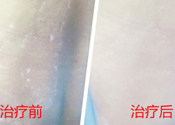 白癜风的早期症状有什么