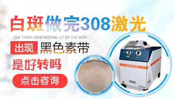 白癜风边缘模糊有色素岛代表什么