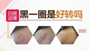 白癜风治疗一个半月边缘颜色变深怎么回事