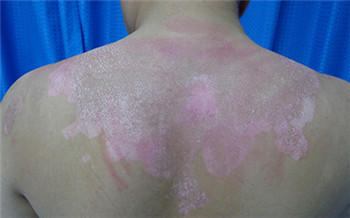 前胸和后背有白斑颜色不均是什么疾病