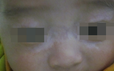 2岁多宝宝额头和鼻子有白片