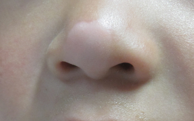 鼻子白癜风早期图片