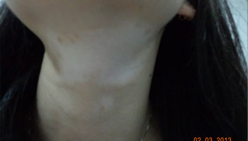脖子上的皮肤发白有点光滑是什么